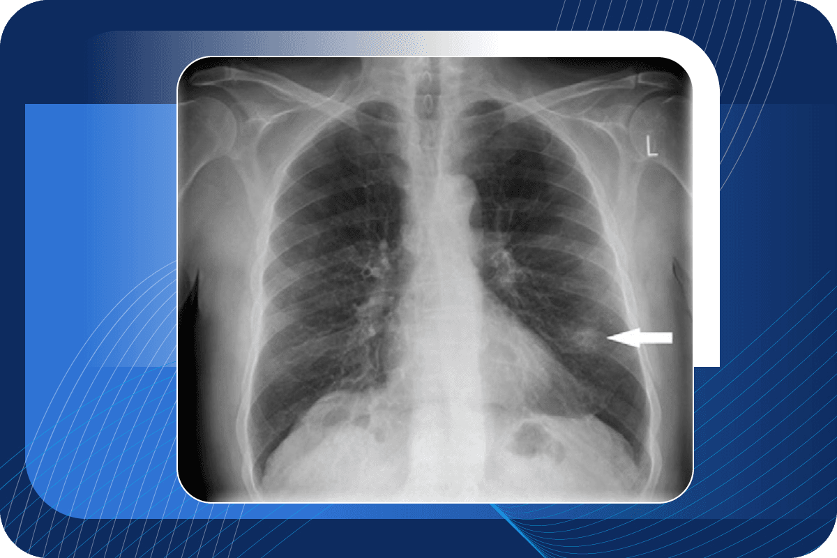 Lung Nodule