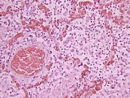 Figure 1. Human ARDS
