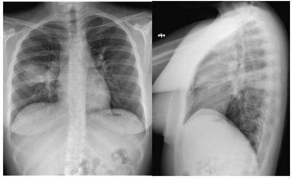 Batty 22 American Thoracic Society | A Batty Non-resolving Lung Abnormality