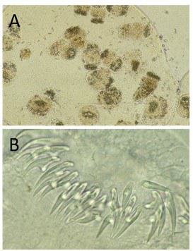Protoscolices In Routine Microscopy American Thoracic Society | A Bloody Mass