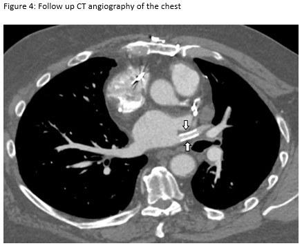 CT Angiogram