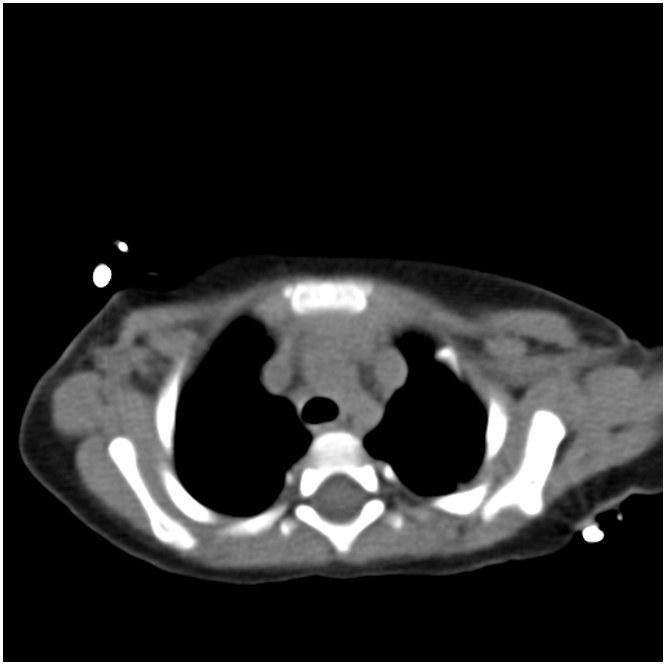 Figure 1: Chest CT findings.