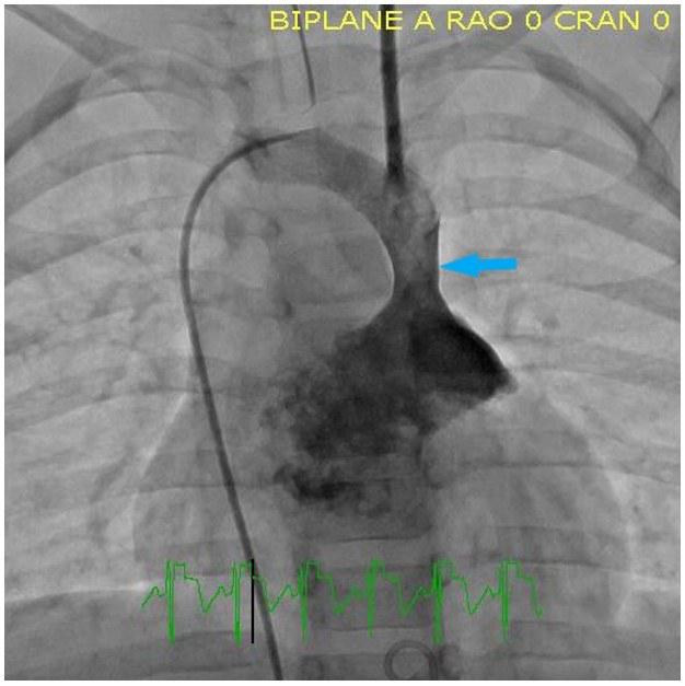 Cardiac catheterization