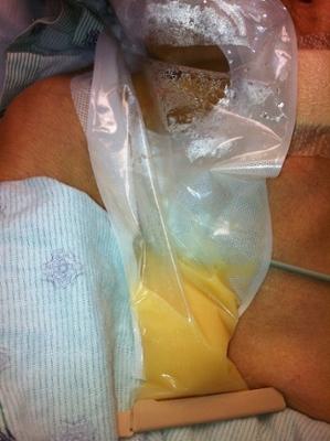 Image 1: Fluid from the catheter insertion site