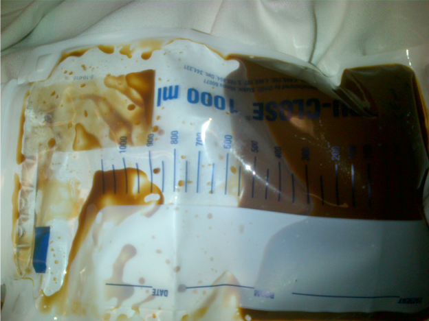 Abscess fluid
