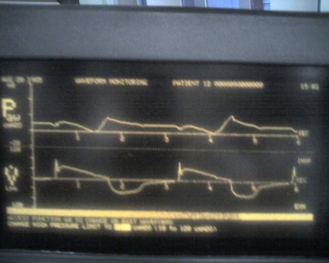Pressure-time and flow-time curves