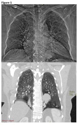 chest film and chest CT scan with IV contrast