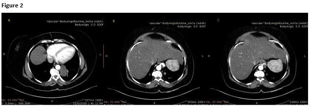 CT Aortogram