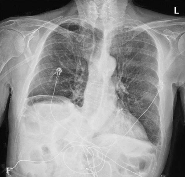 Chest X-ray