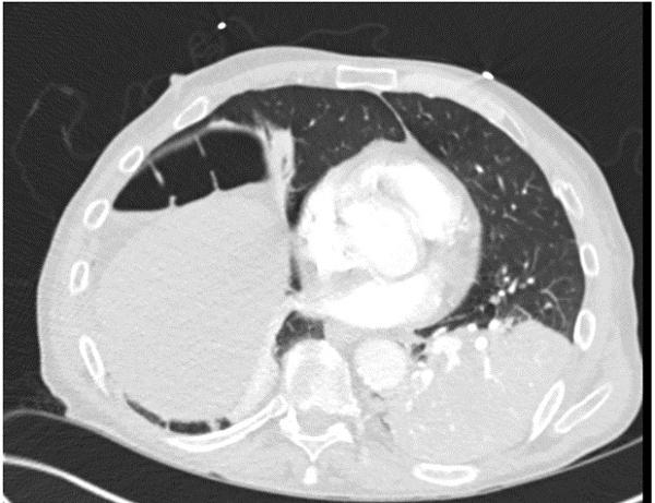CT Scan
