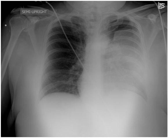 Chest X-Ray