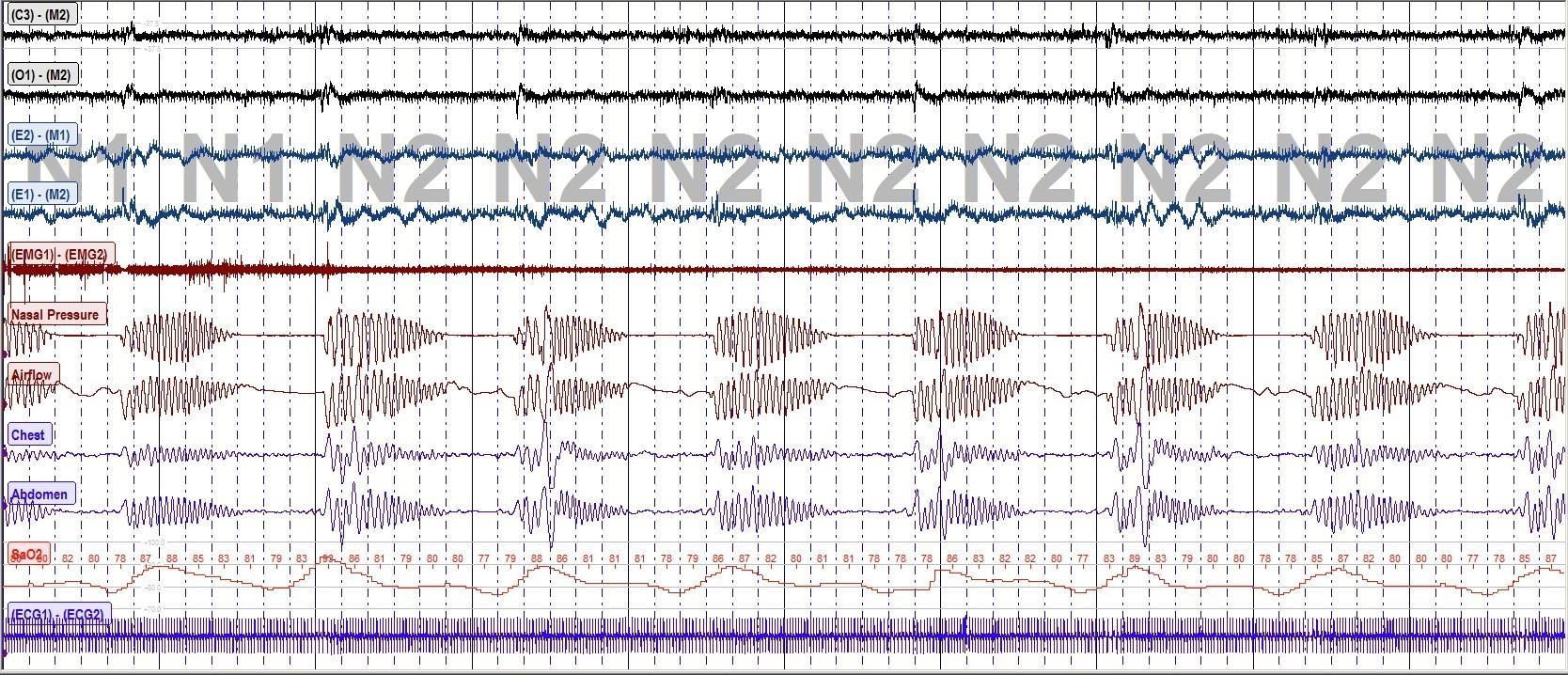baseline polysomnogram