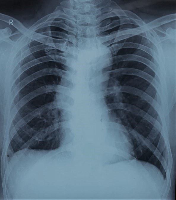 chest radiograph