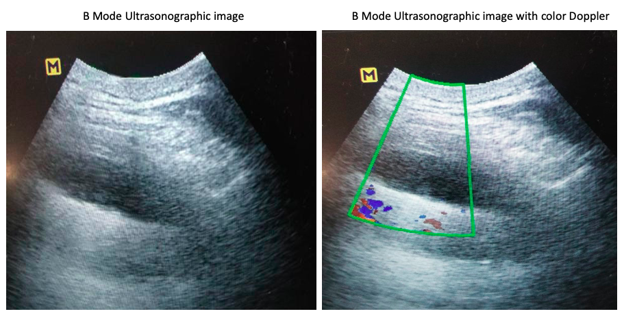 B mode ultrasonographic image of the right lower chest wall alone and with the colour Doppler