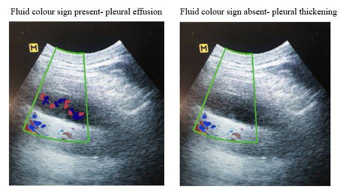 illustrative image of colour Doppler ultrasound differentiating pleural effusion from pleural thickening