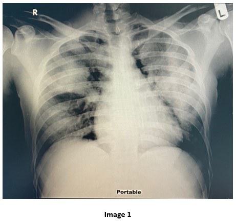 Chest X-Ray