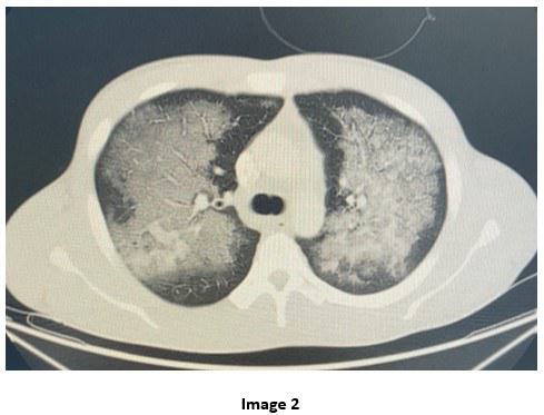 Chest CT