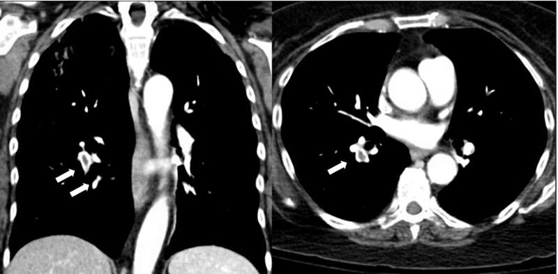 CT scan of the chest that confirmed the diagnosis of bilateral pulmonary emboli