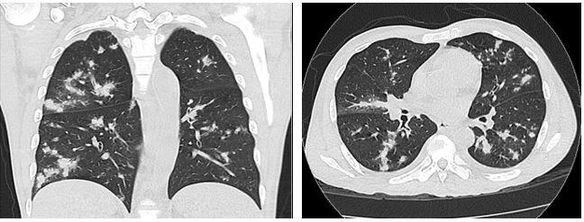 CT Scan