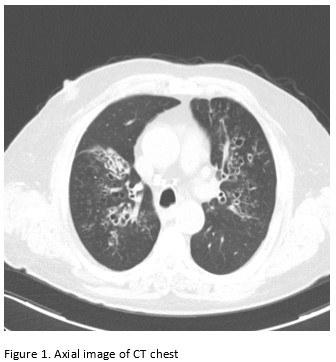 Axial Image of CT Chest