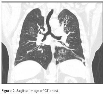 Sagittal Image of CT Chest