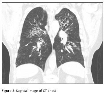 Sagittal Image of CT Chest