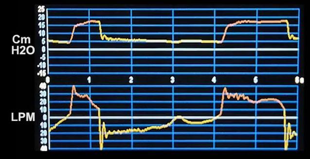 ventilator waveform