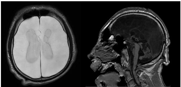 Figure 1: Axial (T2 flair) and Sagittal (T1) MRI images