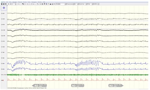 Figure 2: 30 Second Epoch During NREM Sleep
