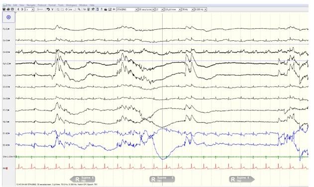 Figure 3: 30 Second Epoch During REM Sleep