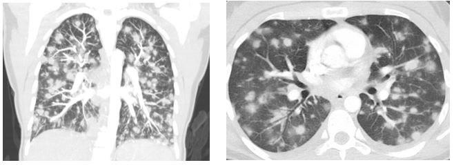 CT Scans