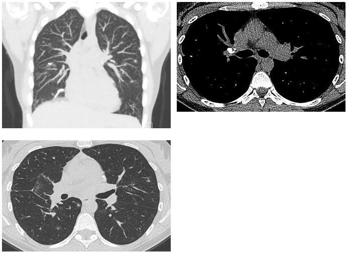 Interval CT Scan