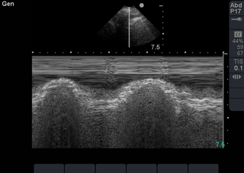bedside lung sonography