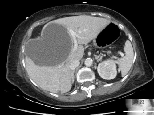 Polycystic Liver