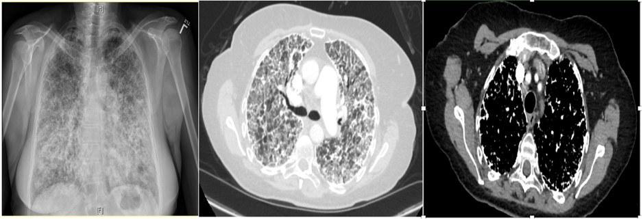 Figure 1. PA chest x-ray (left), Axial plane CT chest with contrast lung and mediastinal window