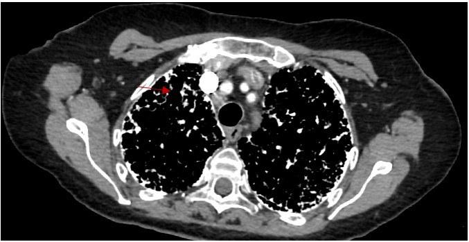Figure 3. HRCT mediastinal window shows the micronodular calcifications