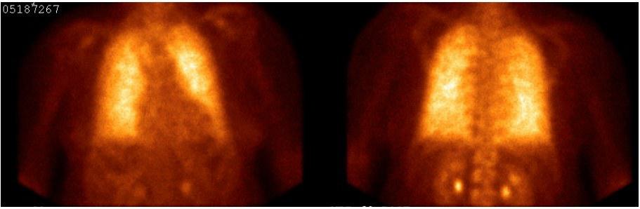 Figure 4. Positive pulmonary bone scintigraphy with bone-avid radiotracer, 99mTc-MDP positive for PAM