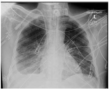 Figure 1: Chest X-ray obtained prior to thoracentesis demonstrating free flowing pleural effusion on the right.