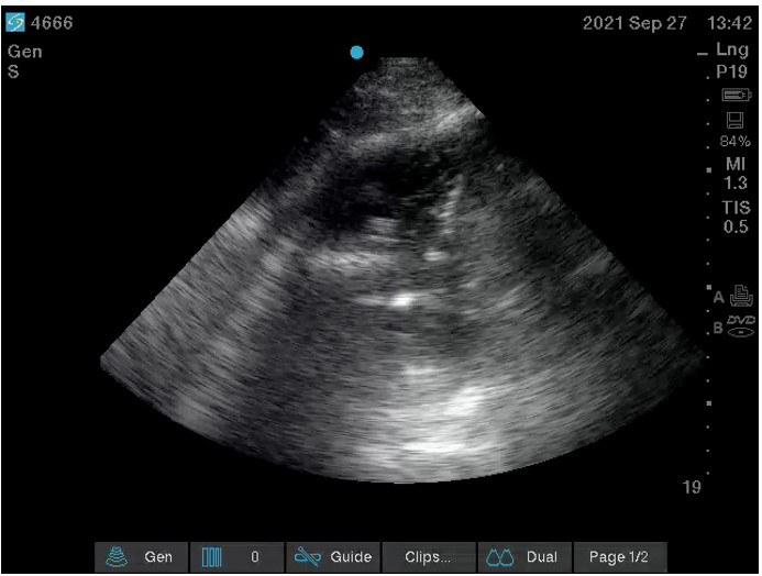 Figure 2: Ultrasound video clip obtained during therapeutic aspiration of pleural fluid
