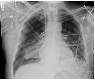 Figure 3: Upright Chest X-ray performed post procedure