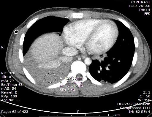 CT Chest