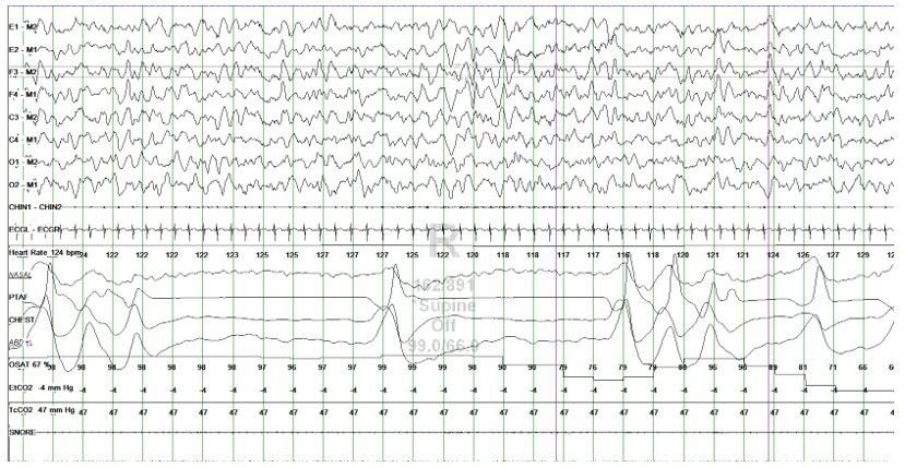 Abnormal breathing pattern during polysomnography