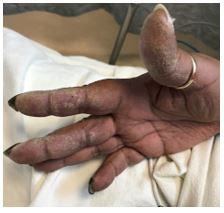 Picture of patient hand