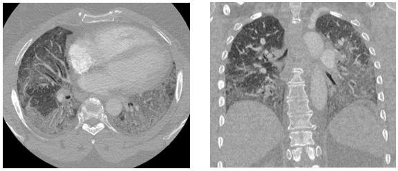 Chest CT Scan