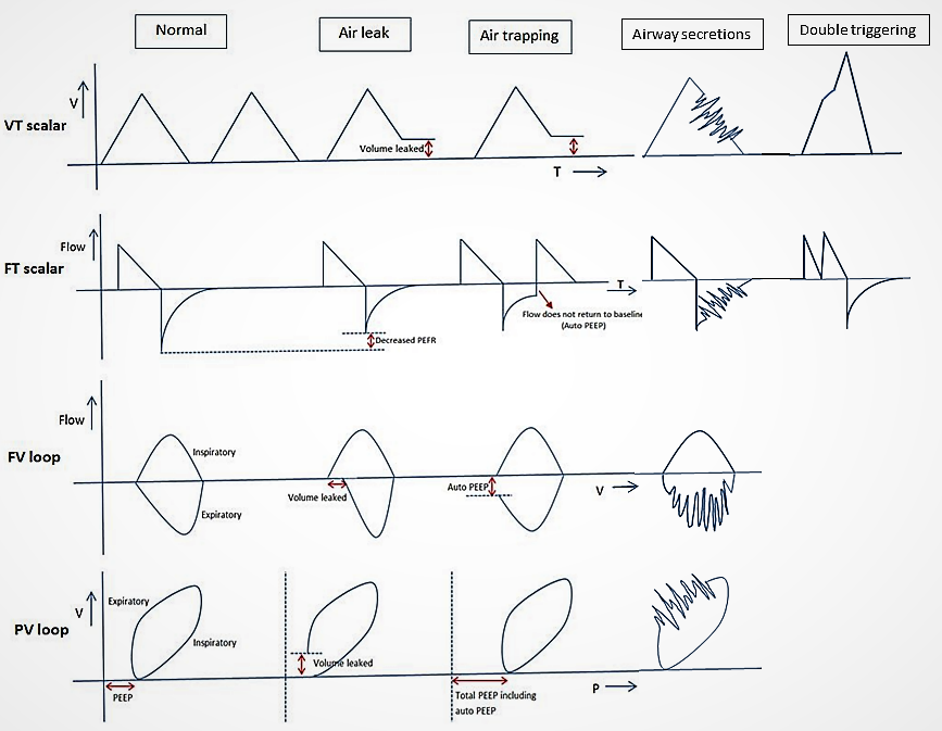 Volume Ramp American Thoracic Society | The Missing Link