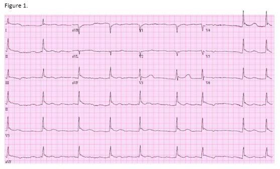 EKG
