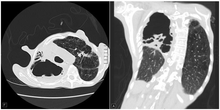 CT Scan