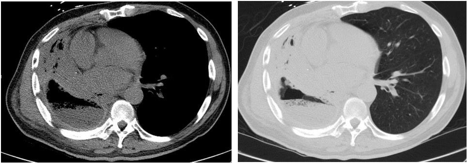 Repeat CT Chest