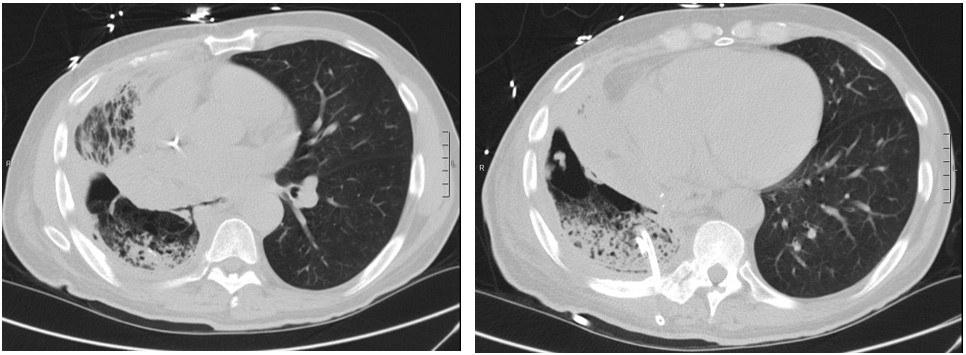 Subsequent CT Chest