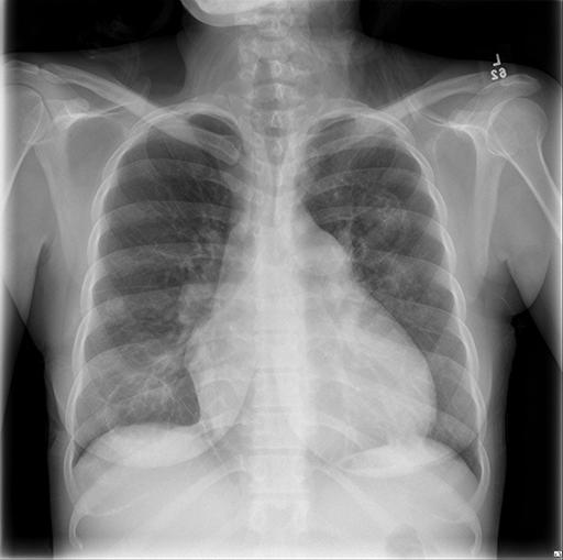 CXR and CT Chest